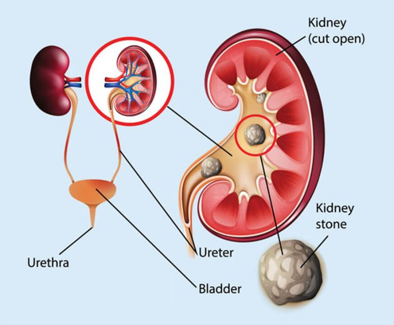 Kidney Stones