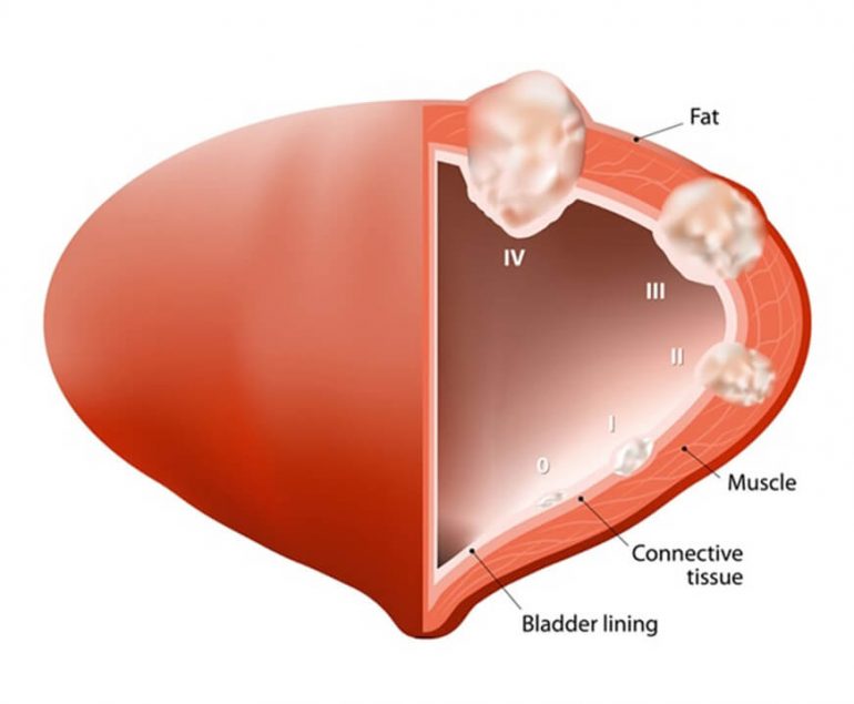 Bladder Cancer