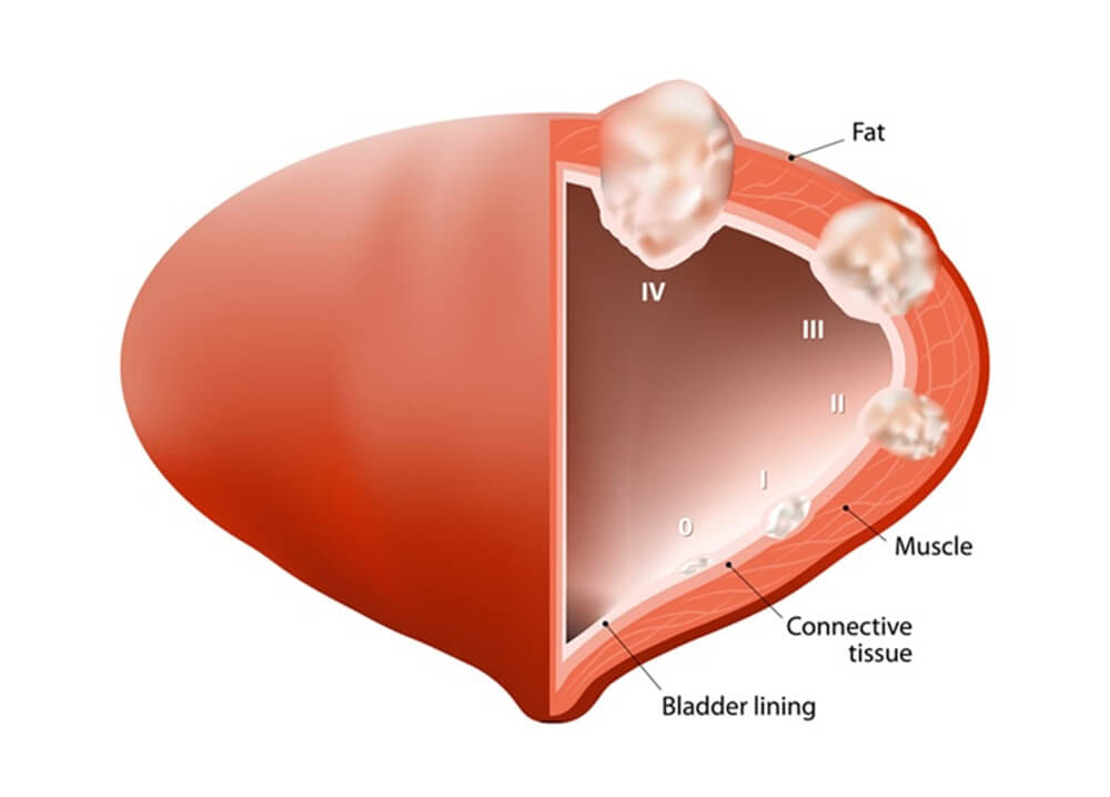 Bladder Cancer