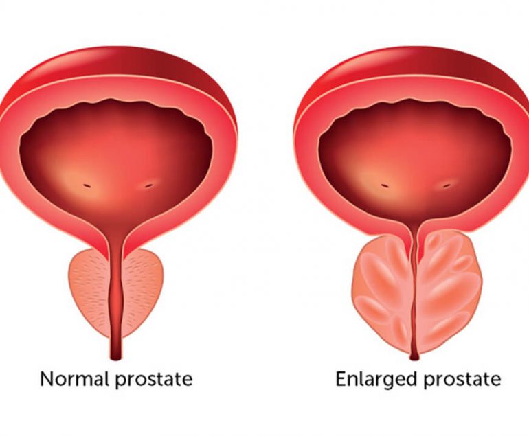 Enlarged Prostate/ BPH