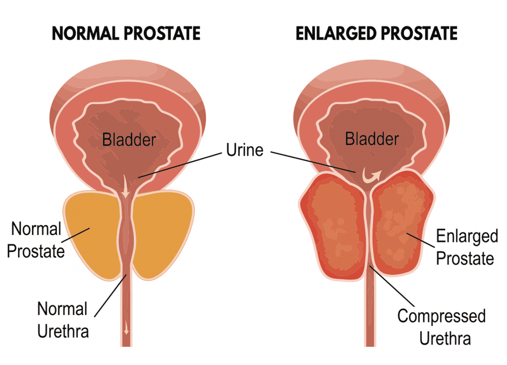 Holep ( Holmium laser enucleation of the prostate)