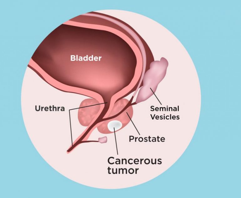 Prostate Cancer