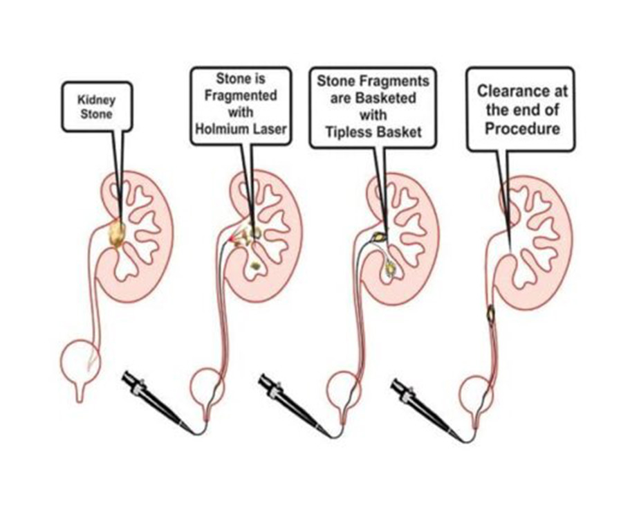 Retrograde Intrarenal Surgery