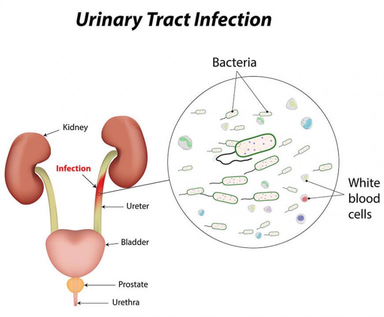 Urinary tract infection