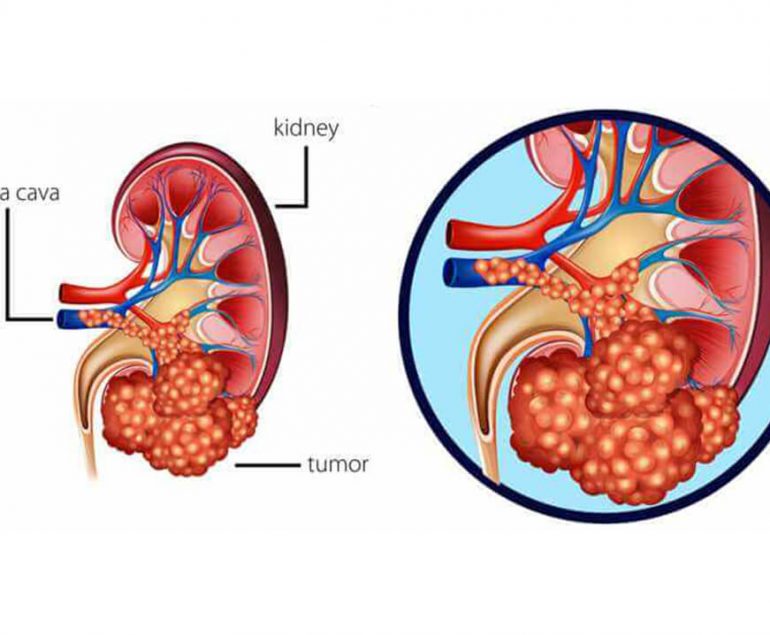 Vasectomy Renal Cancer