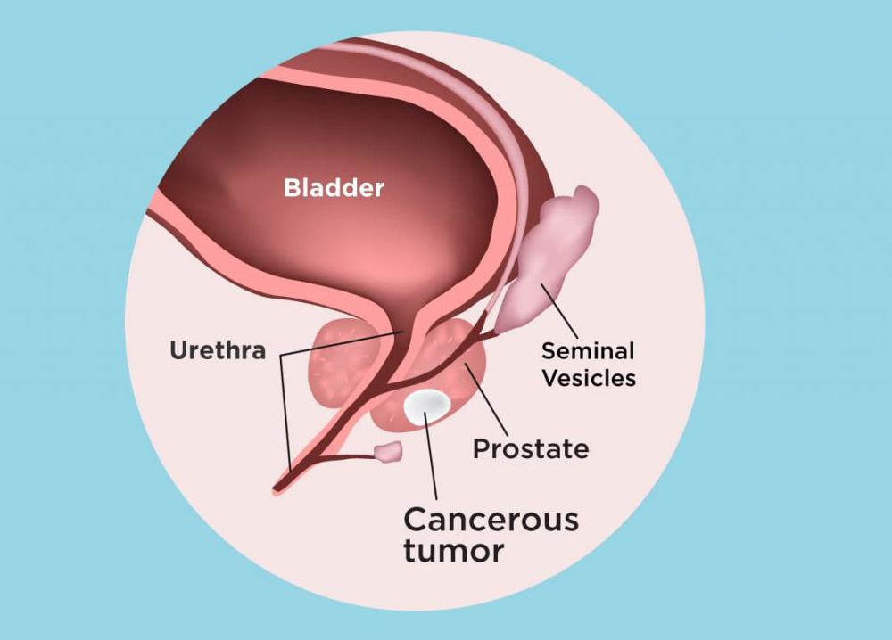 Prostate Cancer