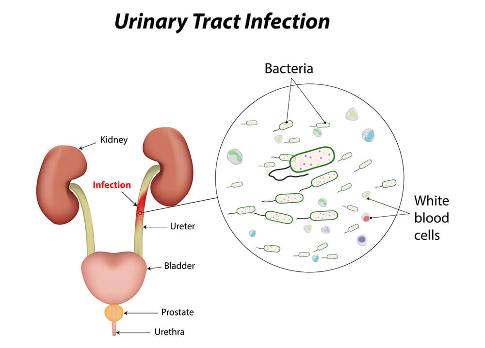 Urinary Tract Infection