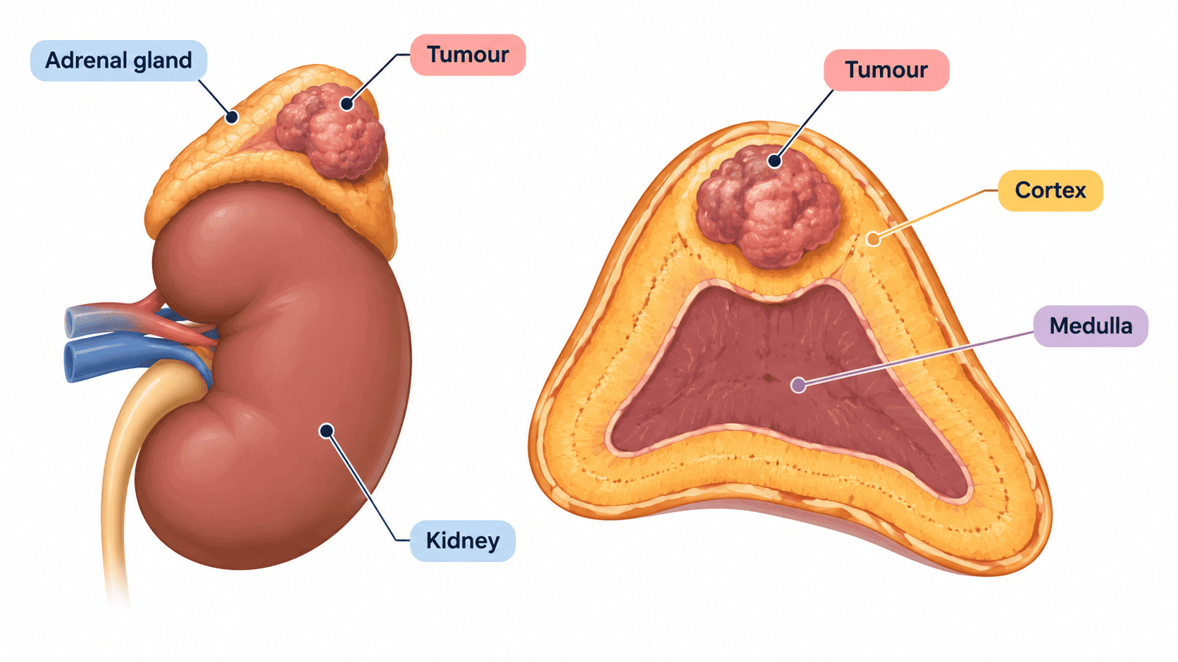 adrenal tumour treatment in chennai